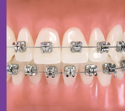 Ortodontia com sistema auto-ligado diminuindo o tempo de tratamento e menos doloroso